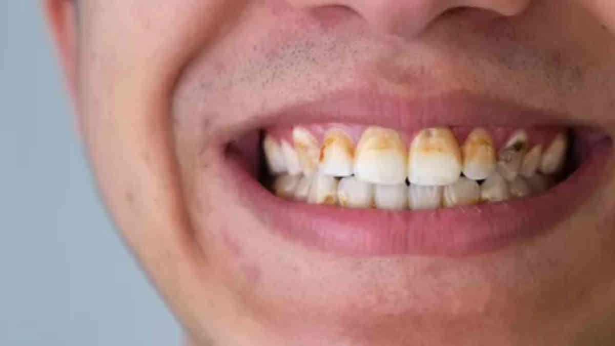 3 Cara Simpel Membersihkan Plak dan Karang Gigi dengan Garam, Cukup 5 Menit Gigi Kembali Bersih